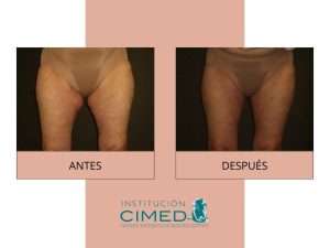 Hidrolipoclasia caso de éxito